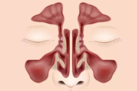 sinusitis_inflamación